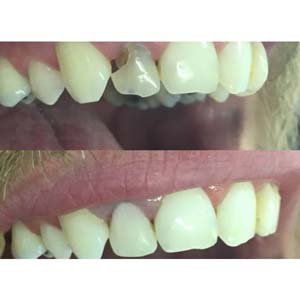 طب الأسنان – ملء الأسنان التجميلية 2023-8