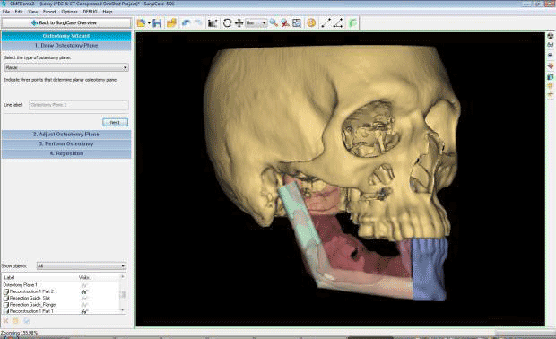 Pictures · Materialise ProPlan CMF 3.0.1
